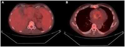 Case report: Coxiella burnetii endocarditis in the absence of evident exposure